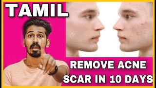 REMOVE ACNE SCAR IN 10 DAYS  TAMIL  HOUSE OF MAVERICK [upl. by Derfniw]