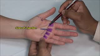 Flexor Tendonitis Hand Injection [upl. by Enilrem]