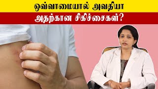 Easily to Cure Urticaria  உடலில் ஏற்படும் ஒவ்வாமை தடுப்பது எப்படி  Samayam Tamil [upl. by Ahsikam]