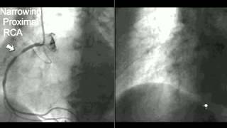 Coronary CT Angiography Cath [upl. by Carey]