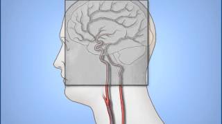 Coronary Angiogram Procedure [upl. by Noiemad615]