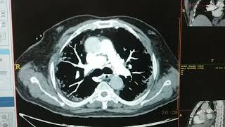 CT PULMONARY ANGIOGRAPHY [upl. by Yrakcaz206]