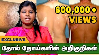 எல்லா தோல் நோய்களுக்கும் இதுதான் தீர்வு  Skin Diseases Treatment in Siddha Thol Noi Pirachanai [upl. by Nylirehs]