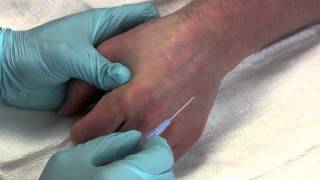 Intravenous Catheter Placement [upl. by Lubow]