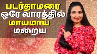 படர்தாமரை மற்றும் தழும்பு ஒரே வாரத்தில் மாயமாய் மறைய  Quickest Way to Get Rid of RINGWORM [upl. by Siroval]