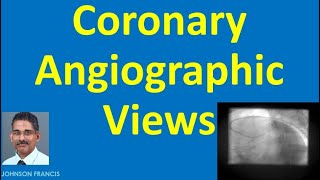 The Road Ahead Coronary Angiogram [upl. by Eleonore]