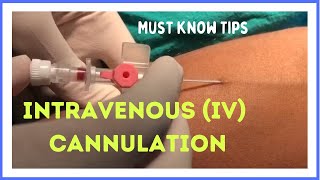 INTRAVENOUS IV CANNULATION in 5 mins How to insert [upl. by Eenal]